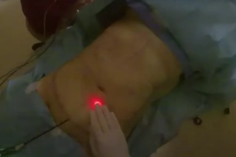 hur fungerar laserfettsugning