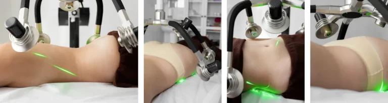 hur lång är återhämtningstiden efter laserfettsugning