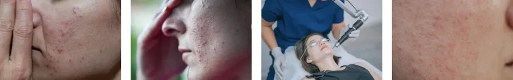hur lång tid tar det att se resultat från laserbehandlingar för rosacea