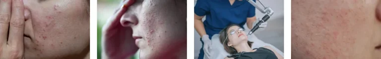 hur lång tid tar det att se resultat från laserbehandlingar för rosacea