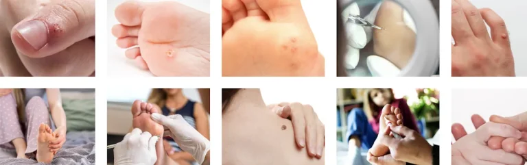 Hur lång tid tar det att se resultat från laserbehandlingar för vårtor