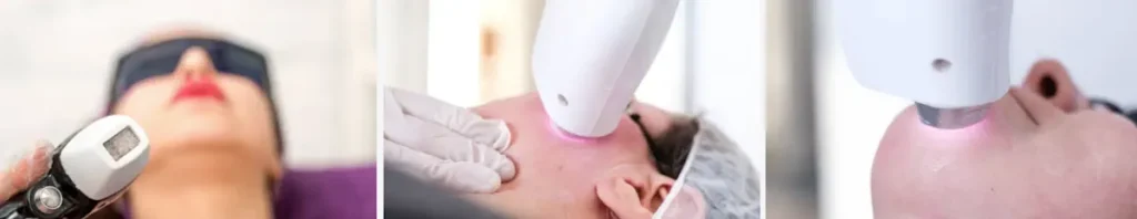 Hur laserbehandlingar kan minska rynkor