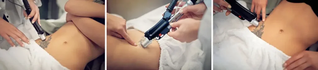 Hur laserborttagning av tatueringar fungerar