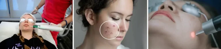 hur många behandlingar behövs för att behandla akne med laser