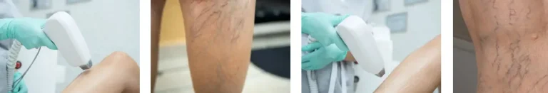 hur många behandlingar behövs för att behandla kärlproblem