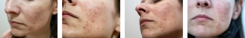 hur många behandlingar behövs för att behandla rosacea