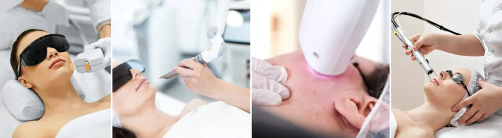 hyperplasi efter laserbehandlingar