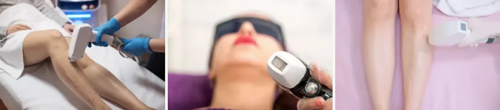 hypertrikos efter laserbehandling