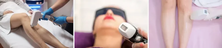 hypertrikos efter laserbehandling