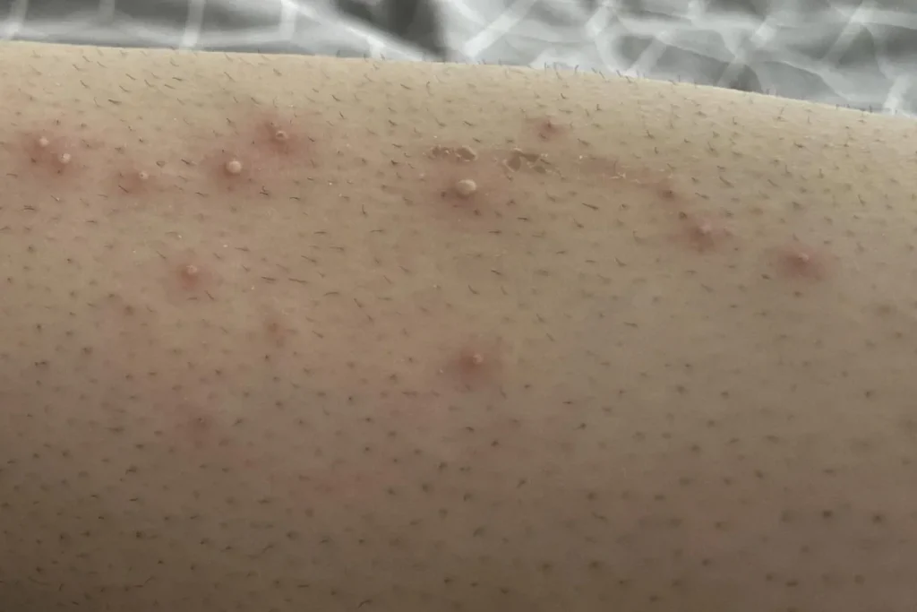 Infektion efter laserbehandling