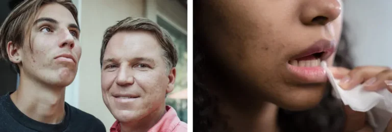 kan laserbehandlingar användas för att behandla acne