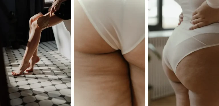 kan laserbehandlingar för celluliter användas på alla delar av kroppen