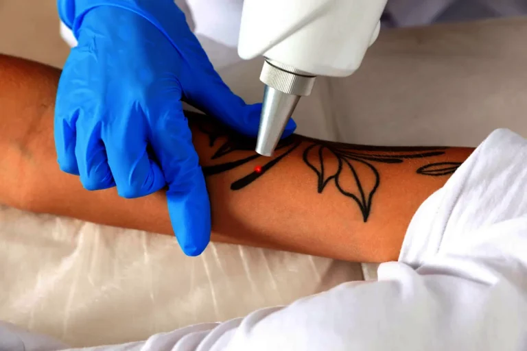 kan laserborttagning av tatueringar orsaka ärr