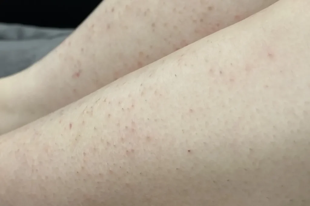 Klåda efter laserbehandling