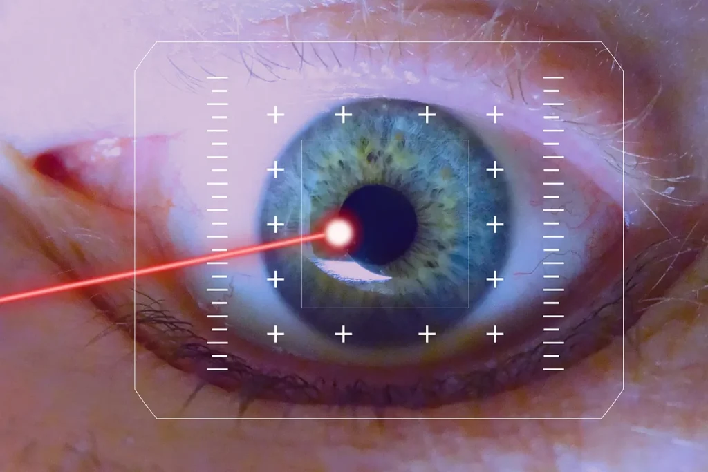 Laser-Assisted in Situ Keratomileusis