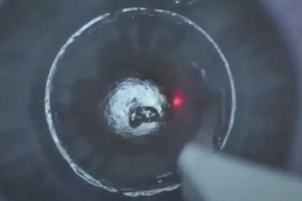 laser-assisted sub-epithelial keratectomy