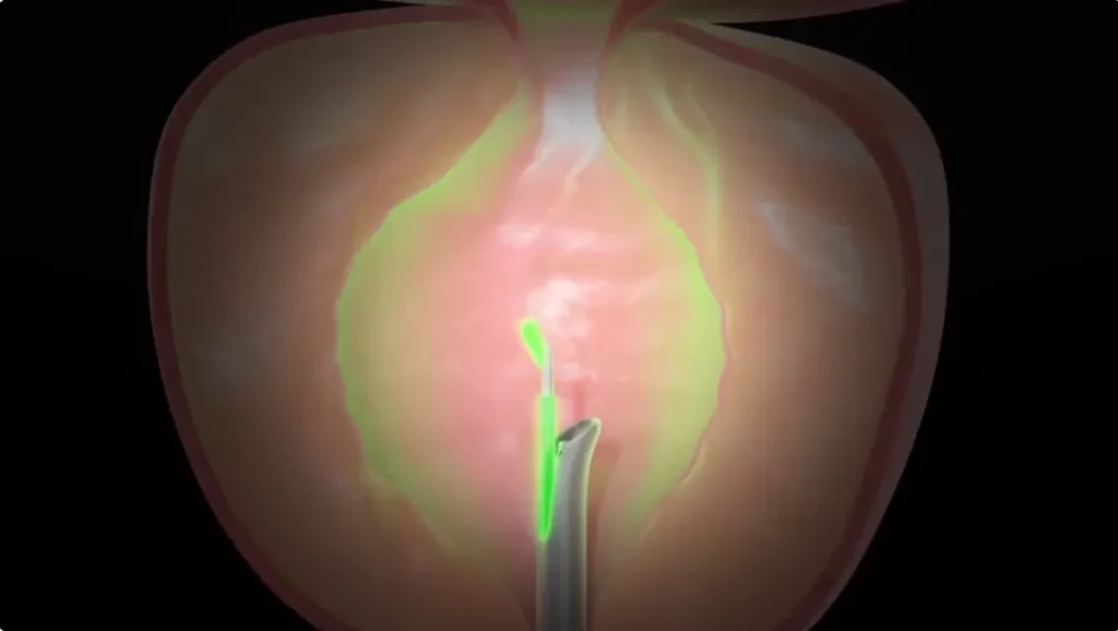 Laserablation av prostata för godartad prostataförstoring