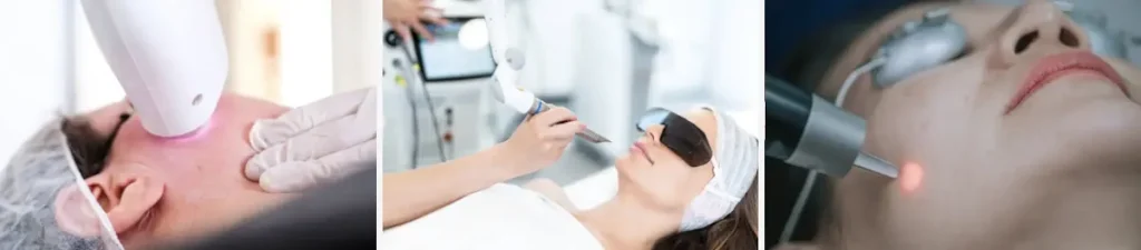 laserbehandling av acneärr