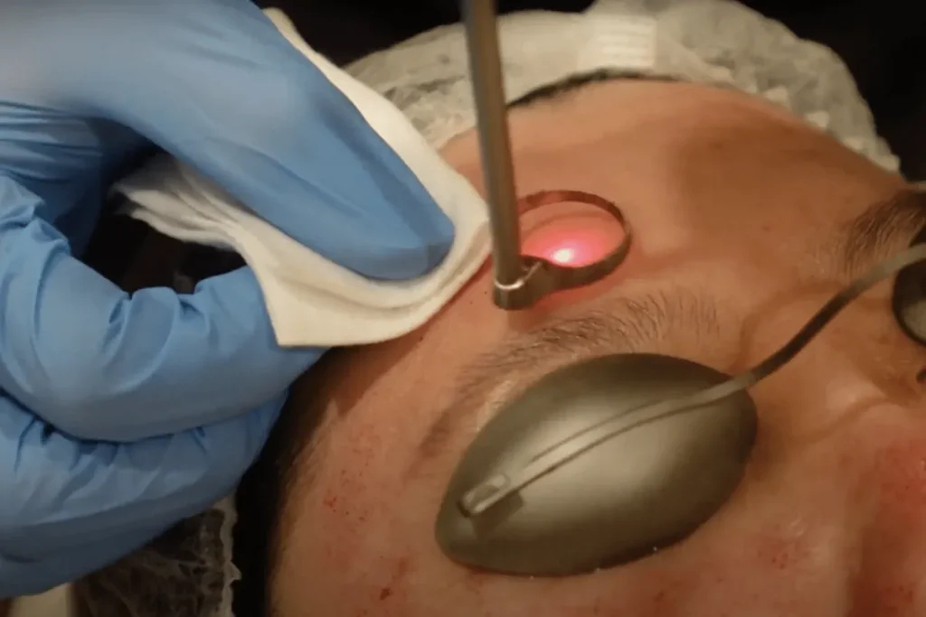 laserbehandling av ärr