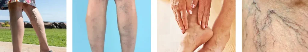 Laserbehandling för åderbråck på benen