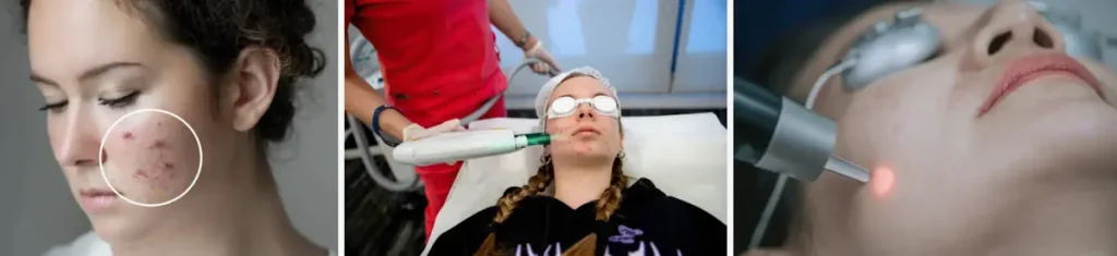 laserbehandling för akne