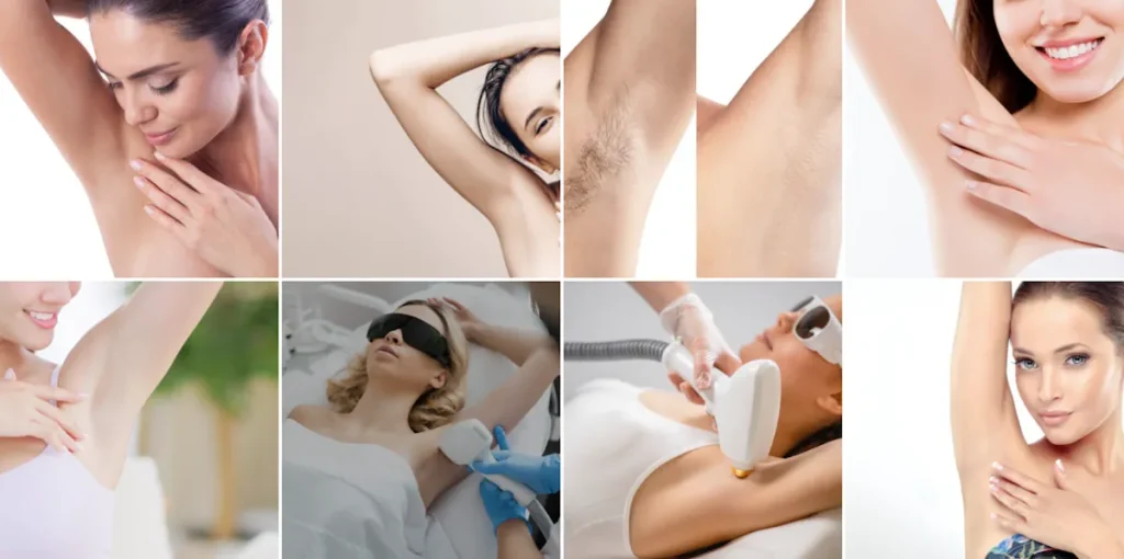 Laserbehandling för armhålor