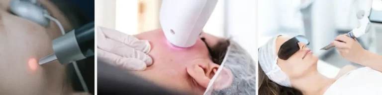 Laserbehandling för att strama åt lös hud