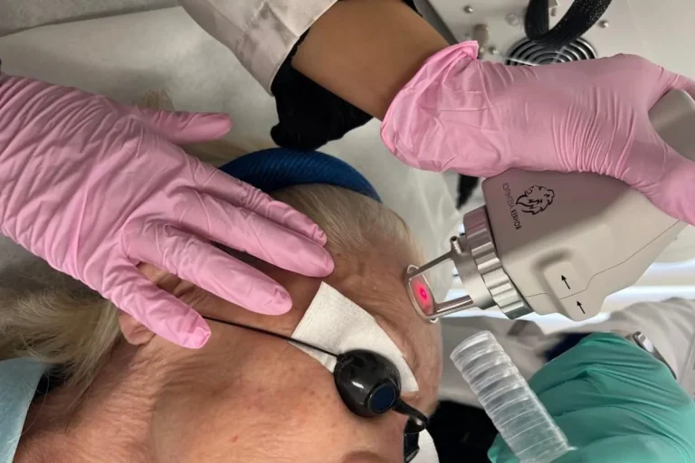 laserbehandling för att ta bort hudfläckar