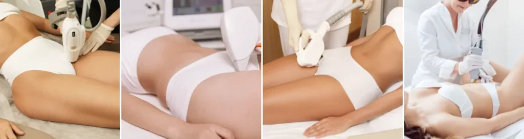 Laserbehandling för bikinihår