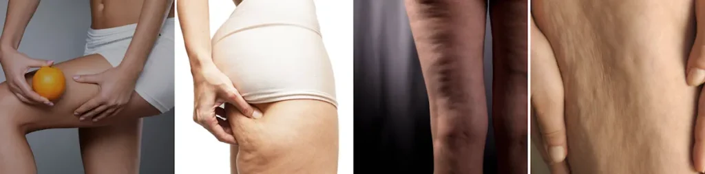 Laserbehandling för celluliter