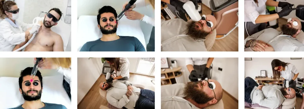 Laserbehandling för hårborttagning i ansiktet