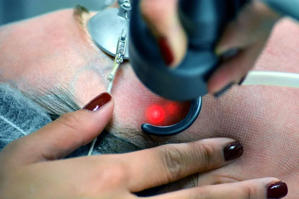 laserbehandling för hudcancer