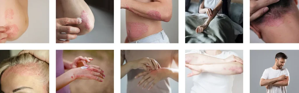 Laserbehandling för hudförbättring efter autoimmuna sjukdomar