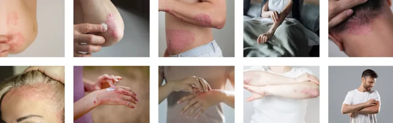Laserbehandling för hudförbättring efter autoimmuna sjukdomar