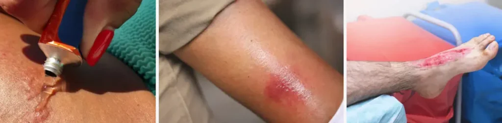 Laserbehandling för hudförbättring efter brännskador