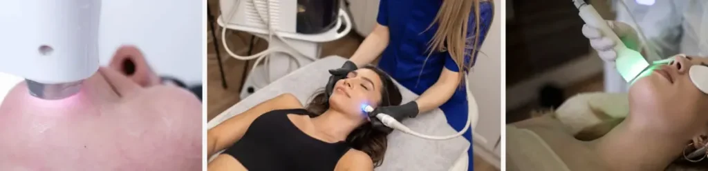 Laserbehandling för hudförbättring efter genetiska sjukdomar