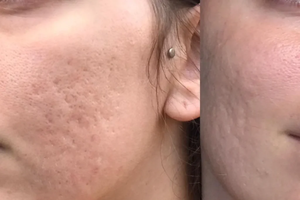 Laserbehandling för hudförbättring efter infektionssjukdomar