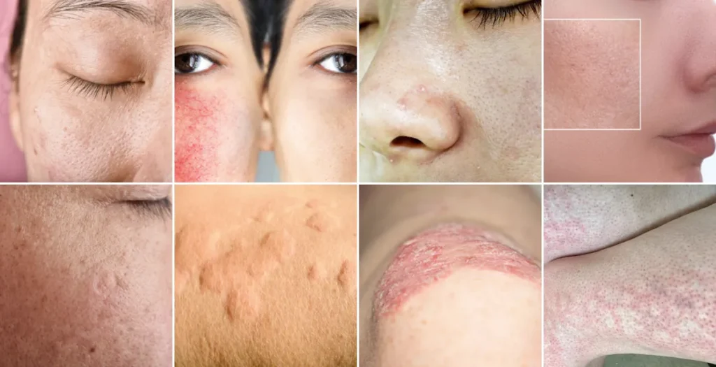 Laserbehandling för hudförbättring efter inflammatoriska sjukdomar