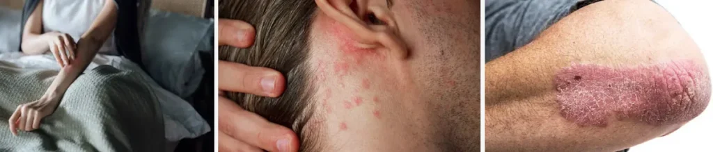 Laserbehandling för hudförbättring efter kroniska sjukdomar