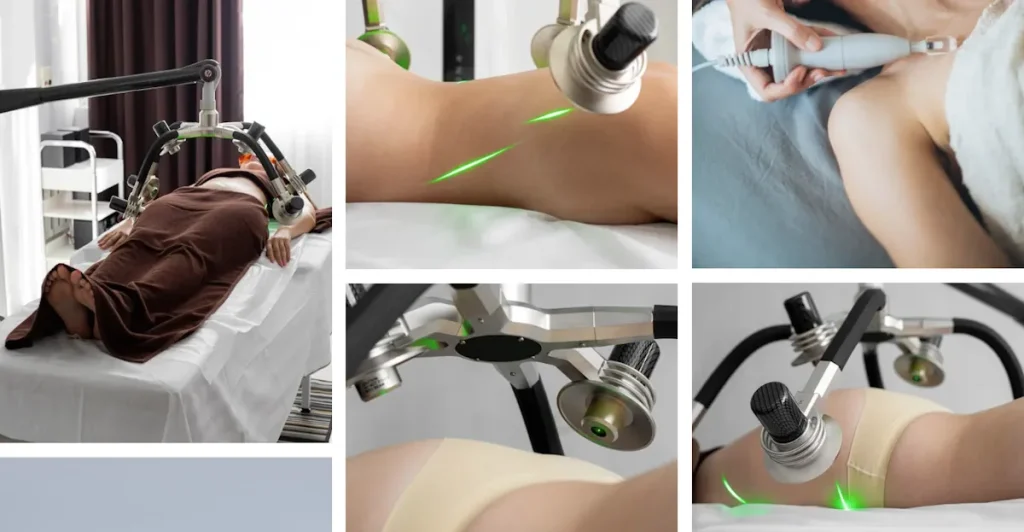 Laserbehandling för hudförbättring efter neurologiska sjukdomar