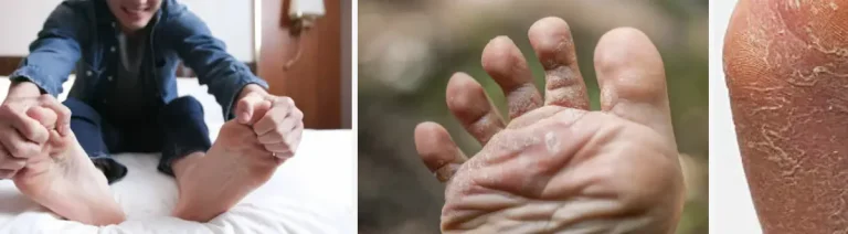 Laserbehandling för hudförbättring efter svampinfektioner