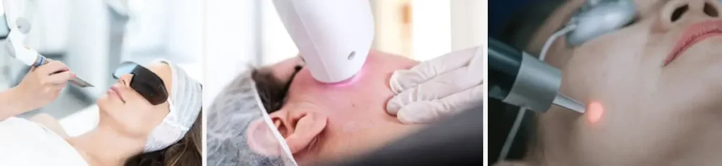 Laserbehandling för hudrodnad