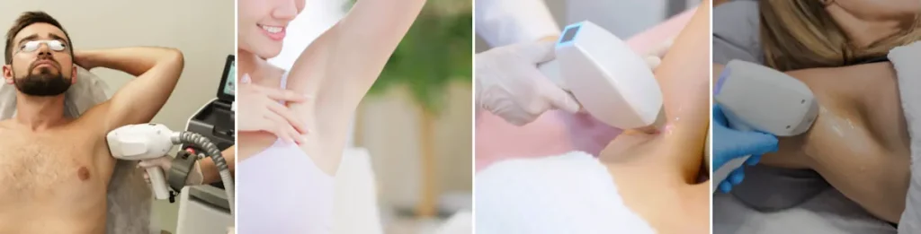 Laserbehandling för kroppshår