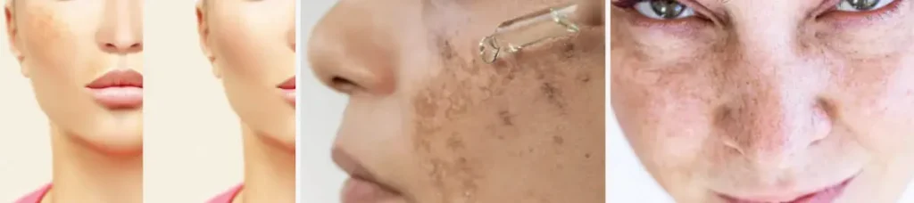 Laserbehandling för melasma