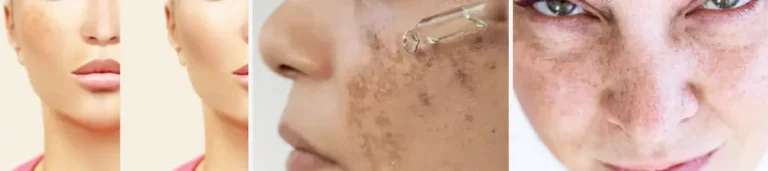 Laserbehandling för melasma