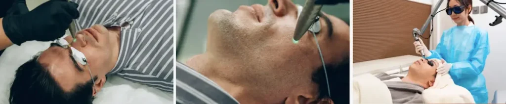 Laserbehandling för minskning av porer