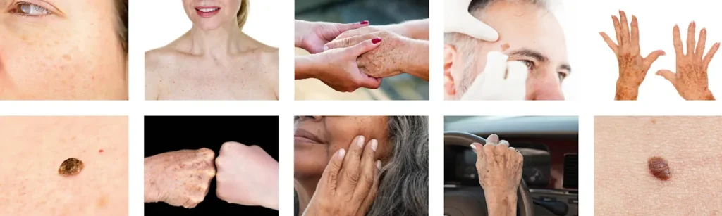 Laserbehandling för pigmentfläckar