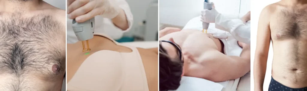 Laserbehandling för rygg och brösthår