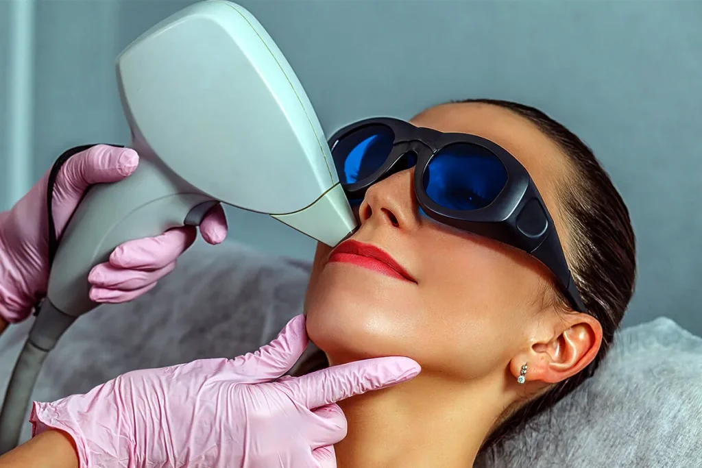 Laserbehandling för rynkor runt munnen