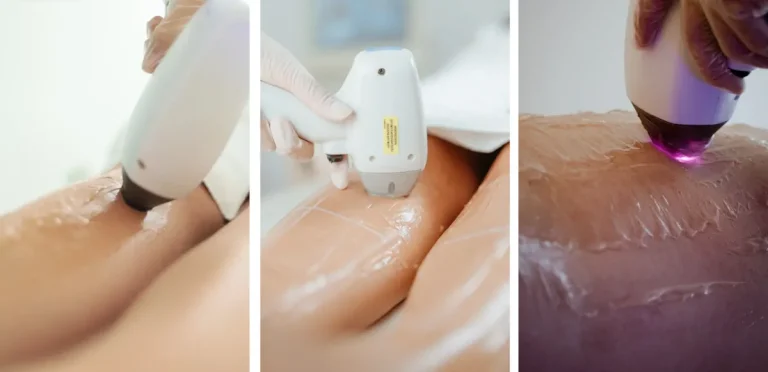 laserbehandling vid celluliter